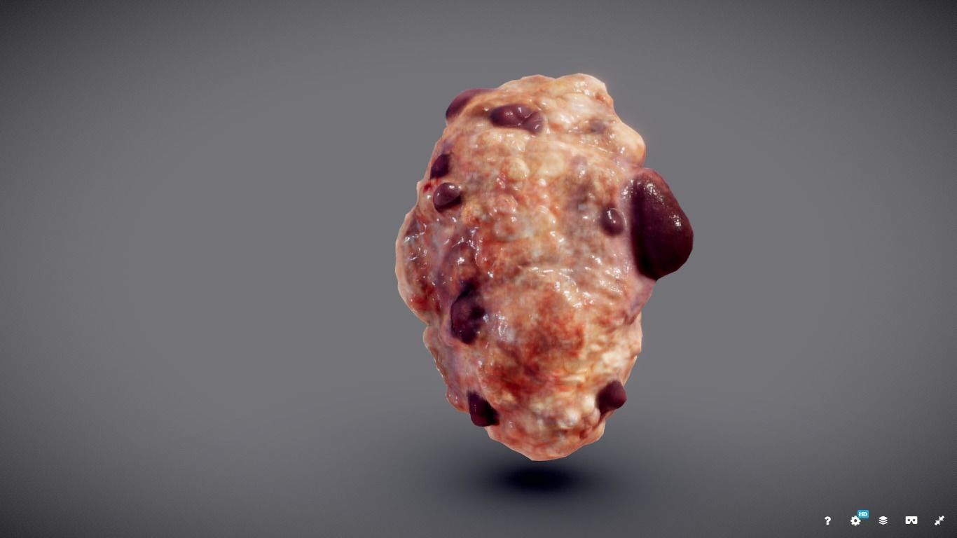 Polycistic Kidney Low-poly 3D model_9