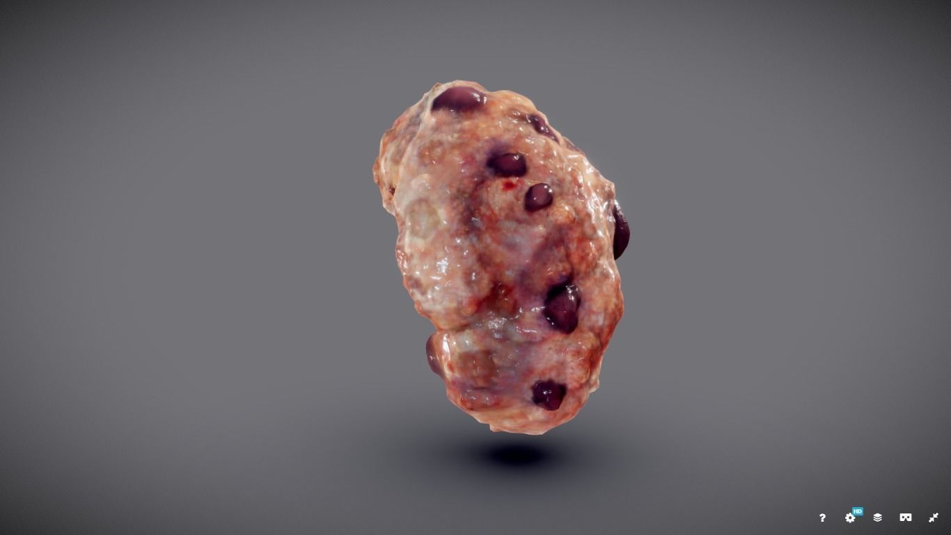 Polycistic Kidney Low-poly 3D model_7