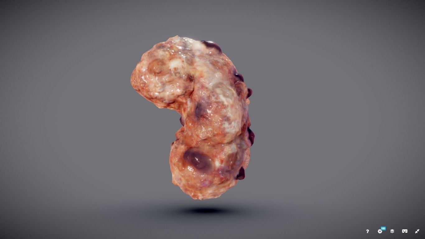 Polycistic Kidney Low-poly 3D model_5