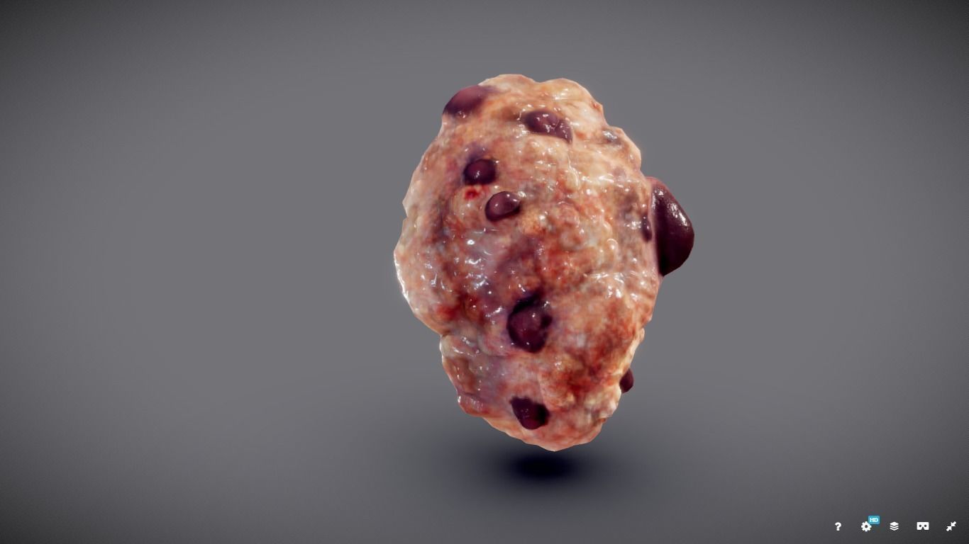 Polycistic Kidney Low-poly 3D model_8
