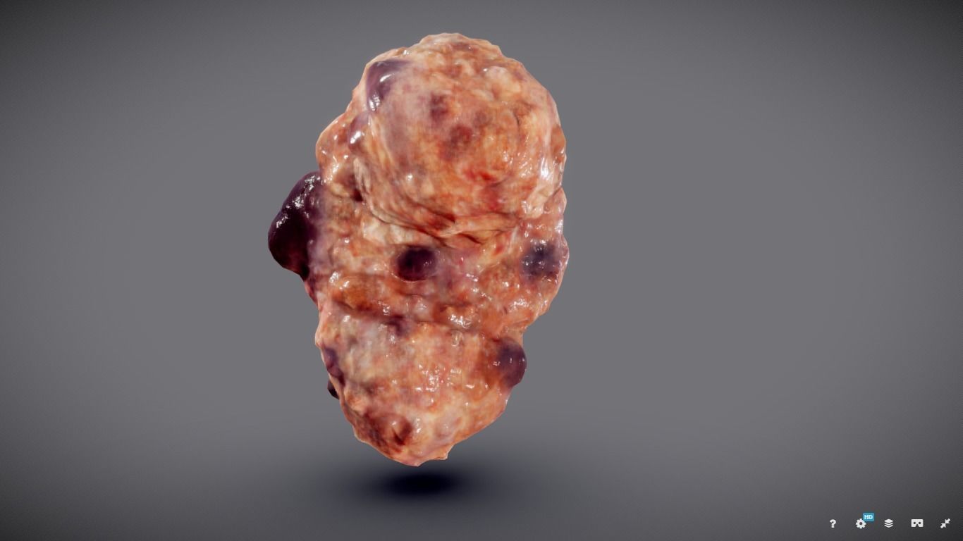 Polycistic Kidney Low-poly 3D model_3