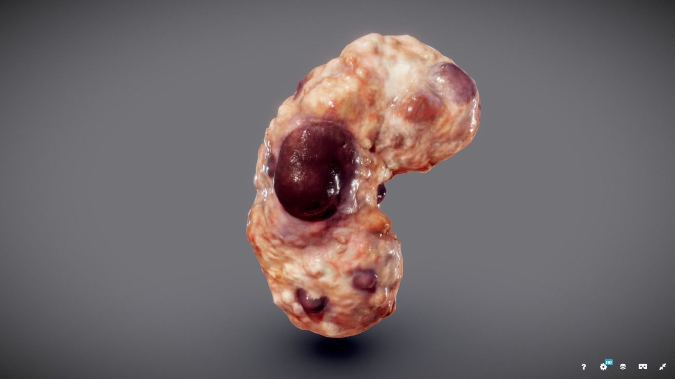 Polycistic Kidney Low-poly 3D model_12