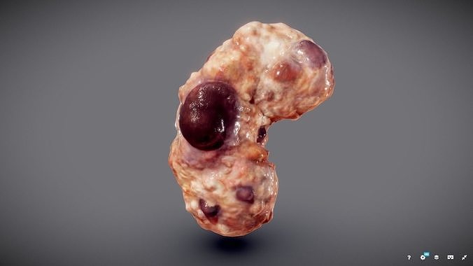 Polycistic Kidney Low-poly 3D model