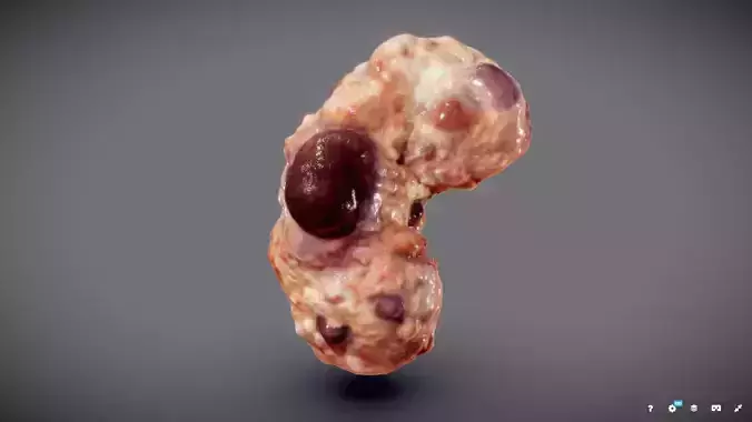 Polycistic Kidney Low-poly 3D model