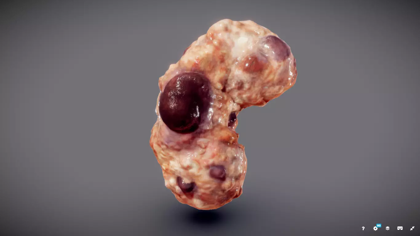 Polycistic Kidney Low-poly 3D model_0