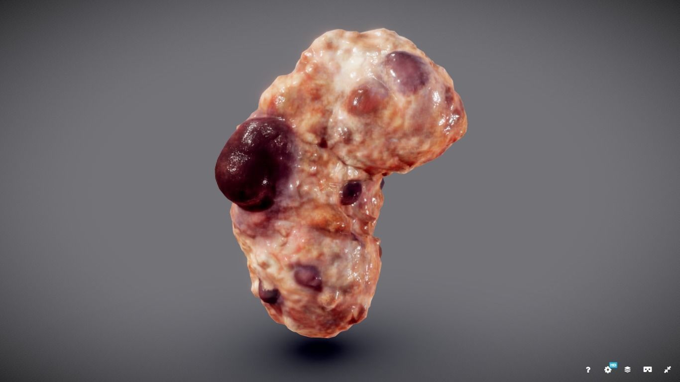 Polycistic Kidney Low-poly 3D model_1