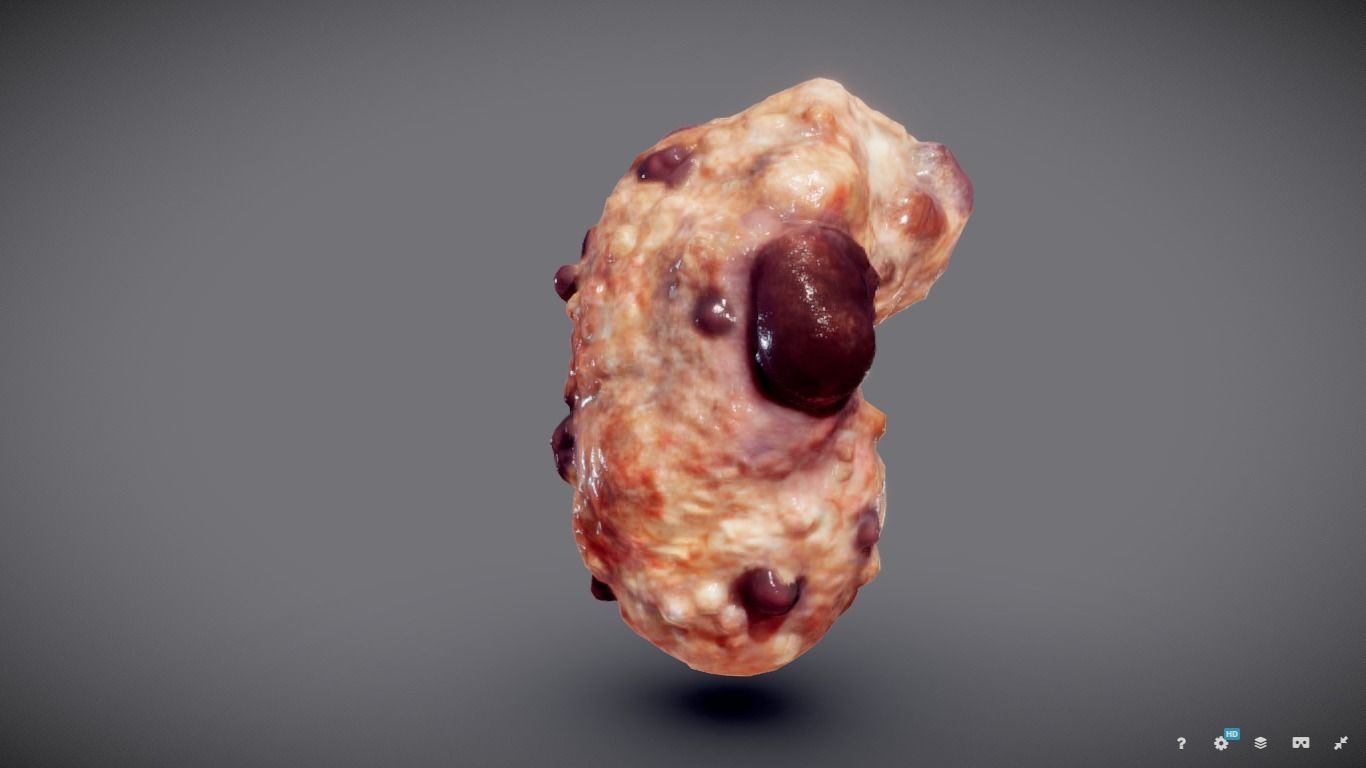 Polycistic Kidney Low-poly 3D model_10