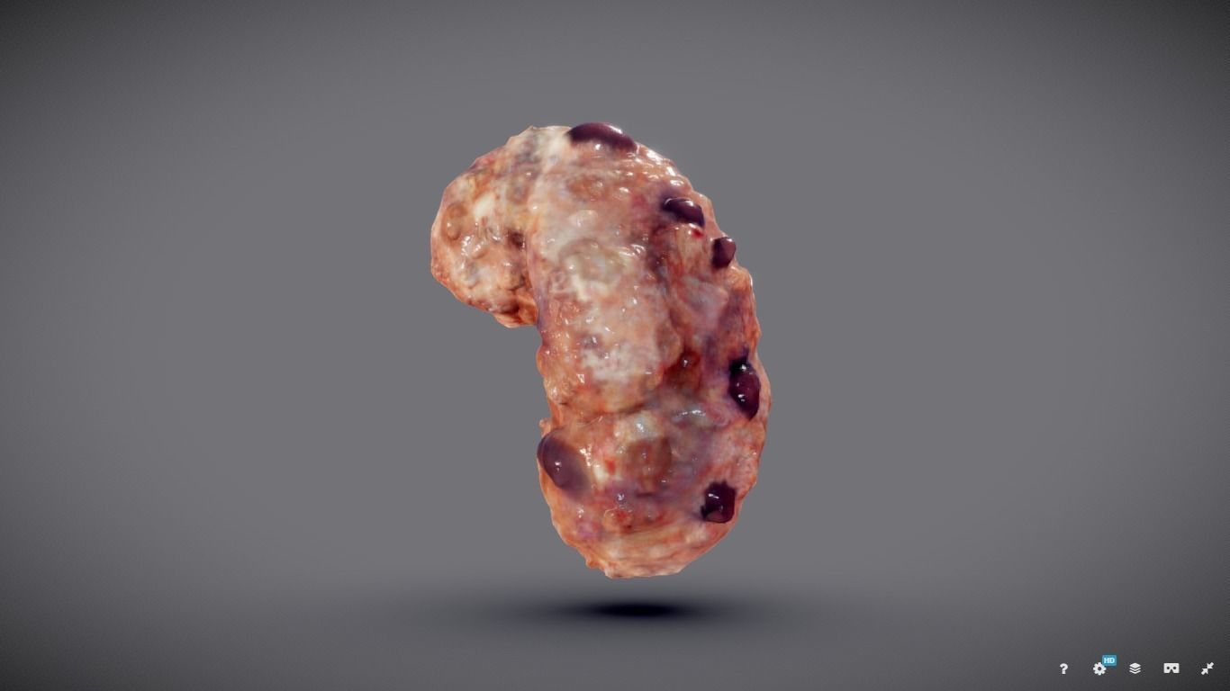 Polycistic Kidney Low-poly 3D model_6