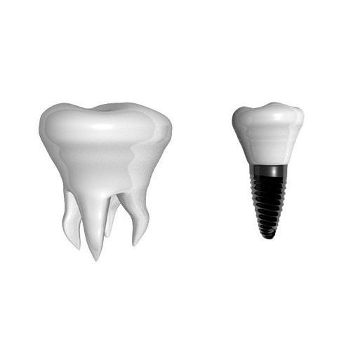 Tooth white implant dentistry prosthetics Free 3D model