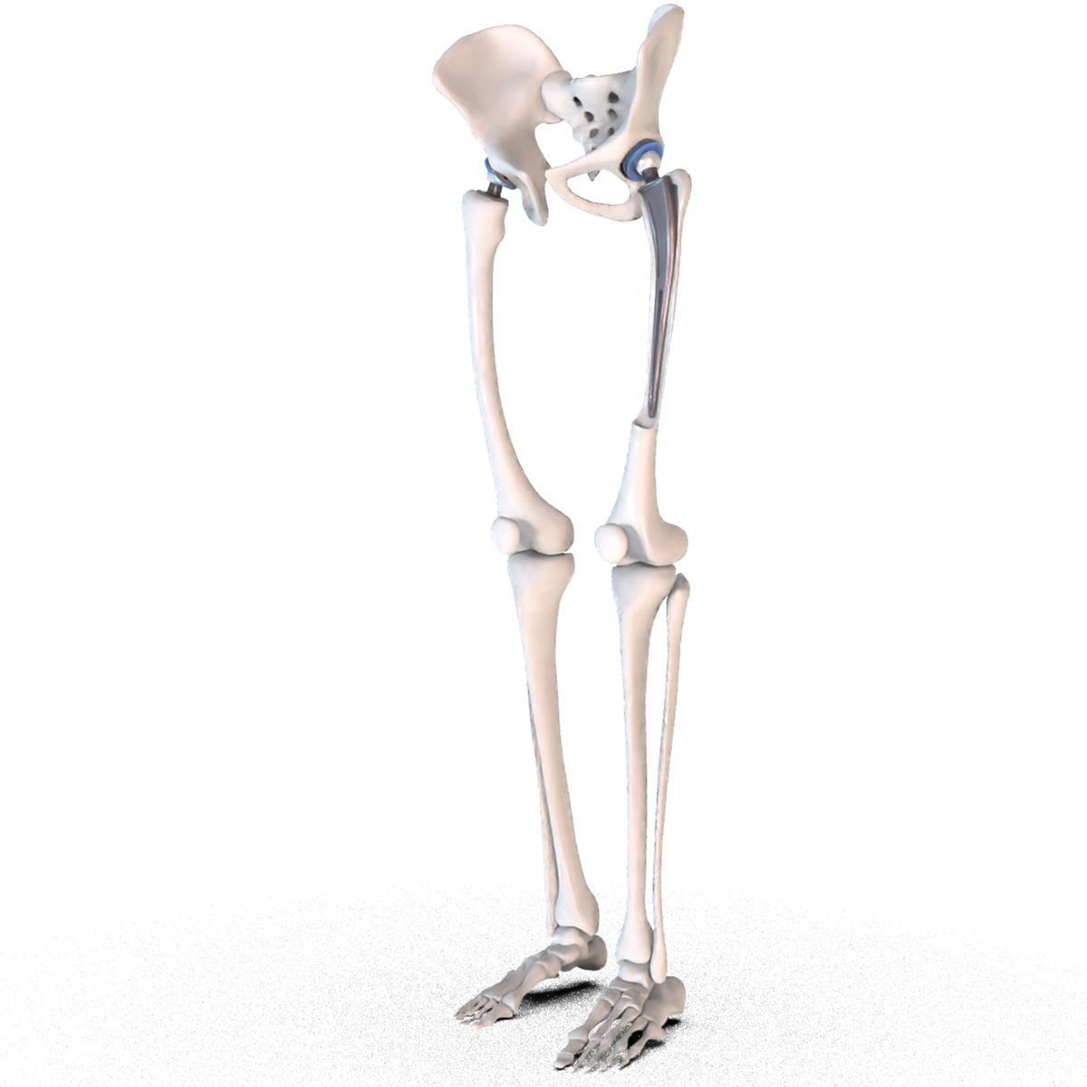 Hip replacement implant installed in the pelvis bone 3D model_9