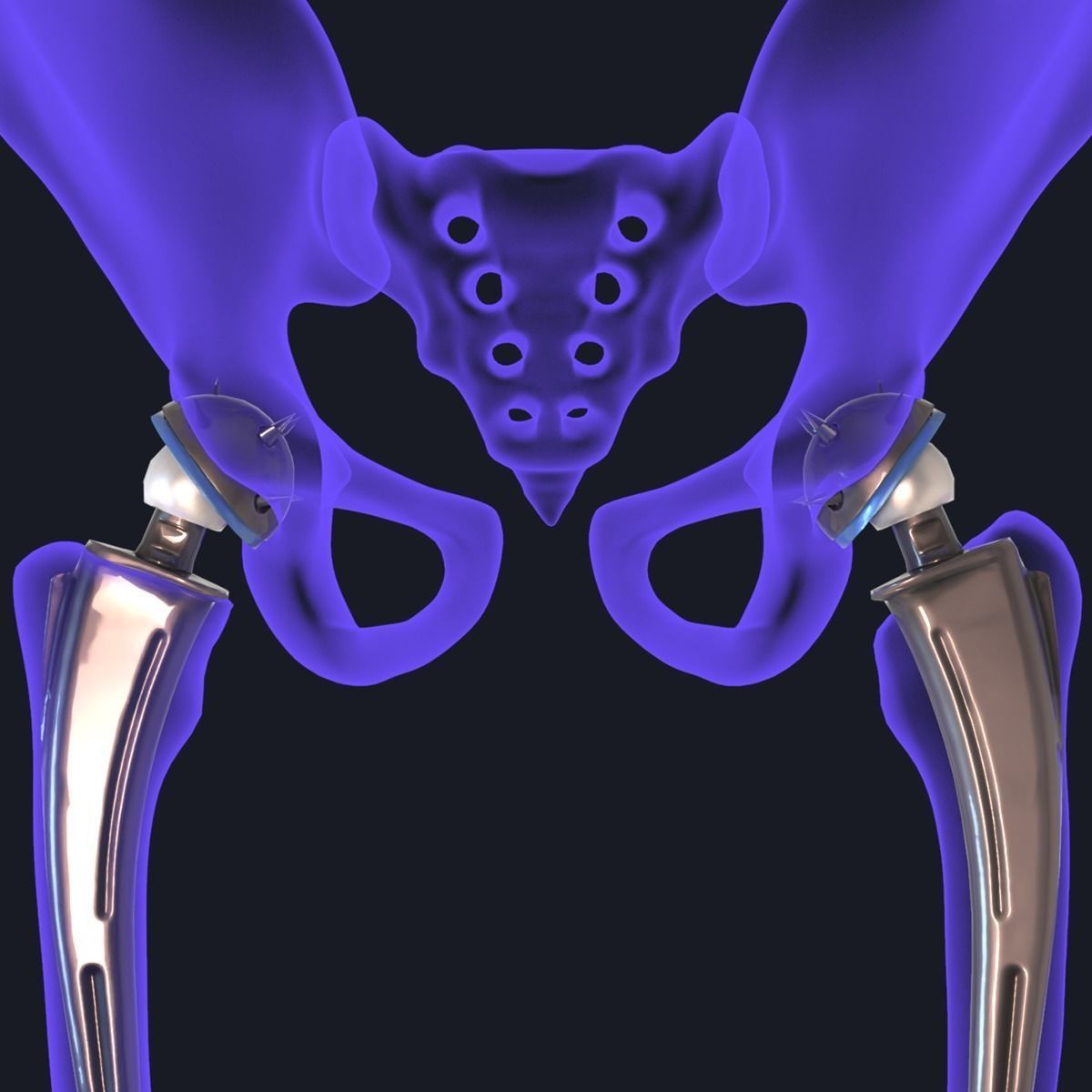 Hip replacement implant installed in the pelvis bone 3D model_21