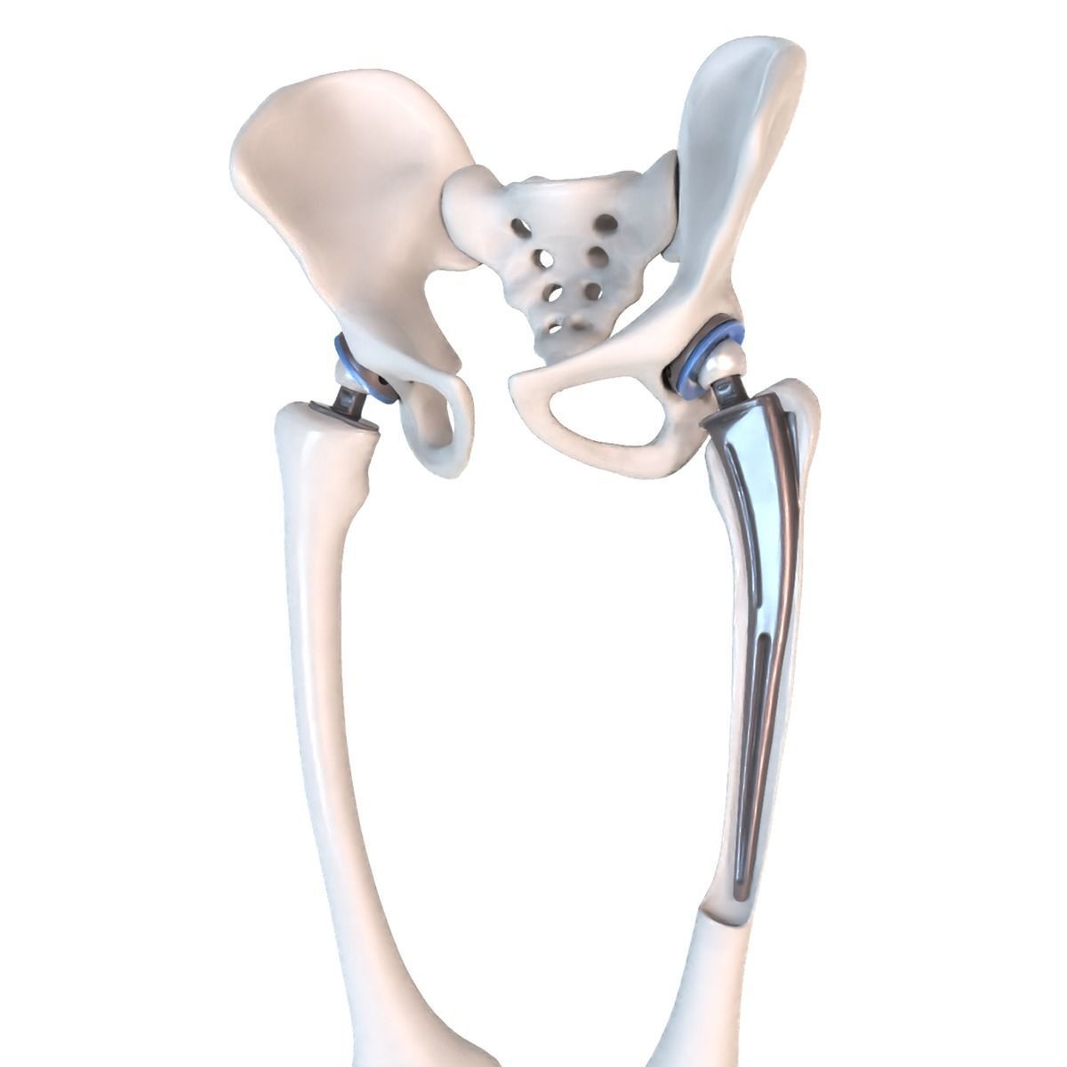 Hip replacement implant installed in the pelvis bone 3D model_4