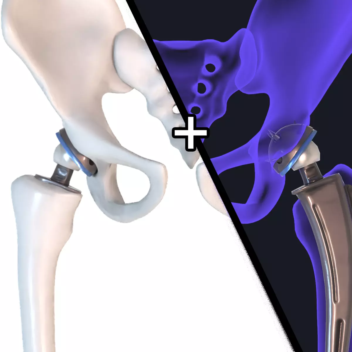 Hip replacement implant installed in the pelvis bone 3D model_0