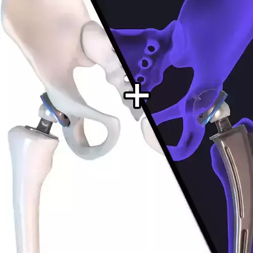 Hip replacement implant installed in the pelvis bone 3D model
