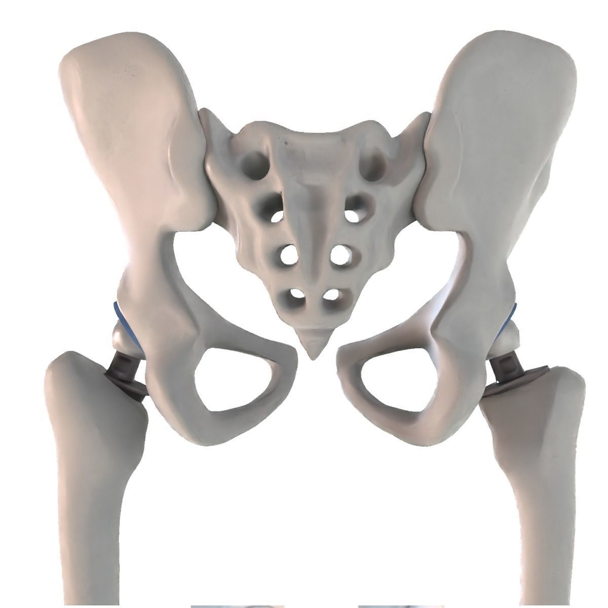 Hip replacement implant installed in the pelvis bone 3D model_5