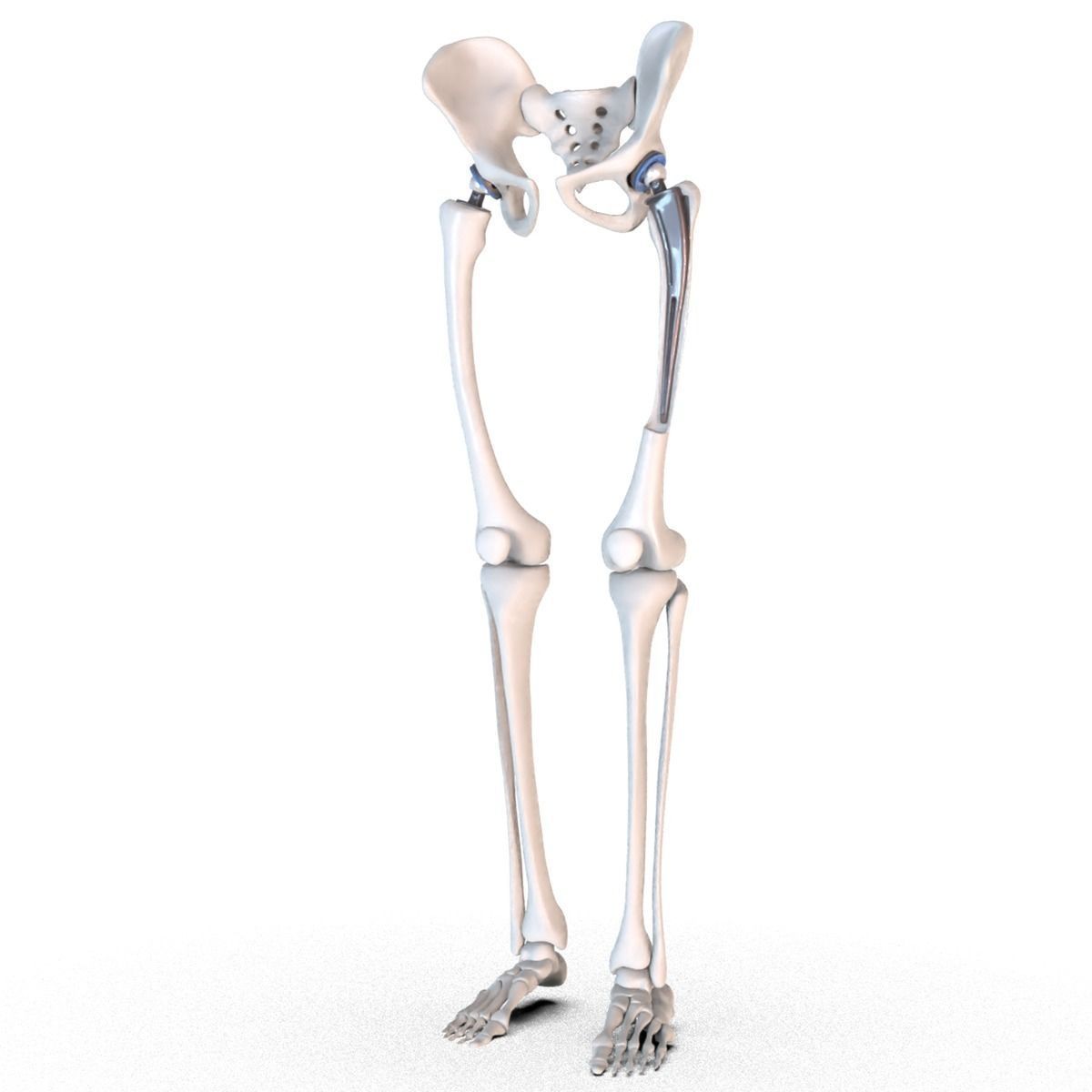 Hip replacement implant installed in the pelvis bone 3D model_6