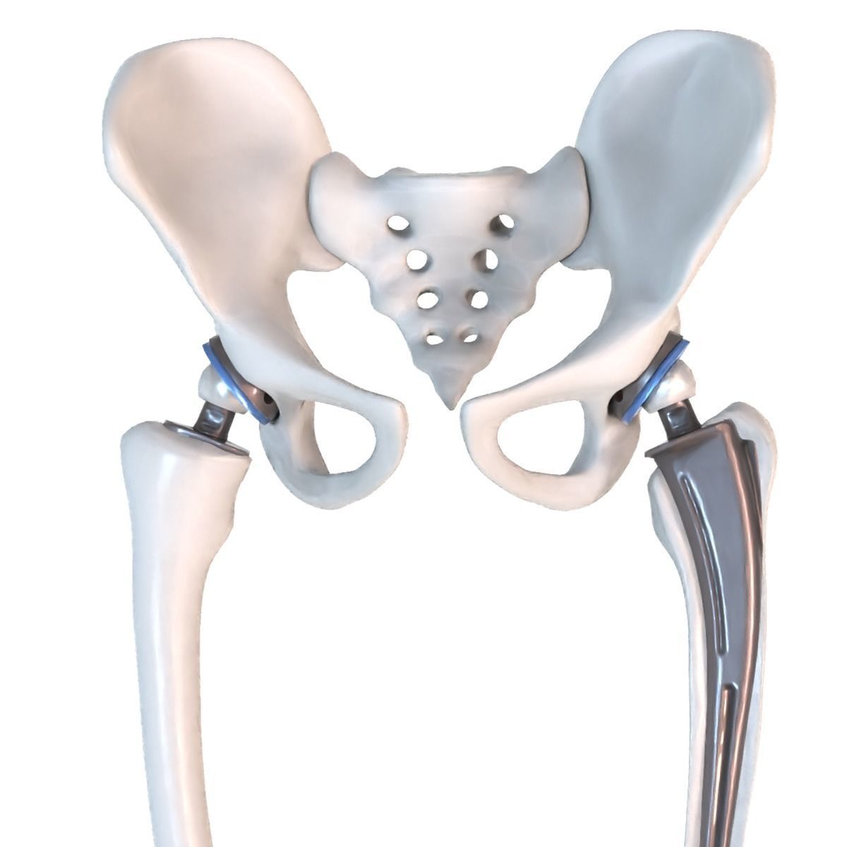 Hip replacement implant installed in the pelvis bone 3D model_2