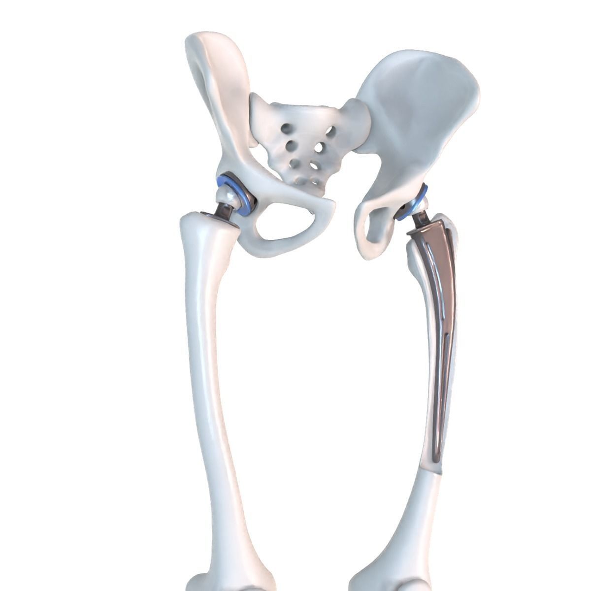 Hip replacement implant installed in the pelvis bone 3D model_3