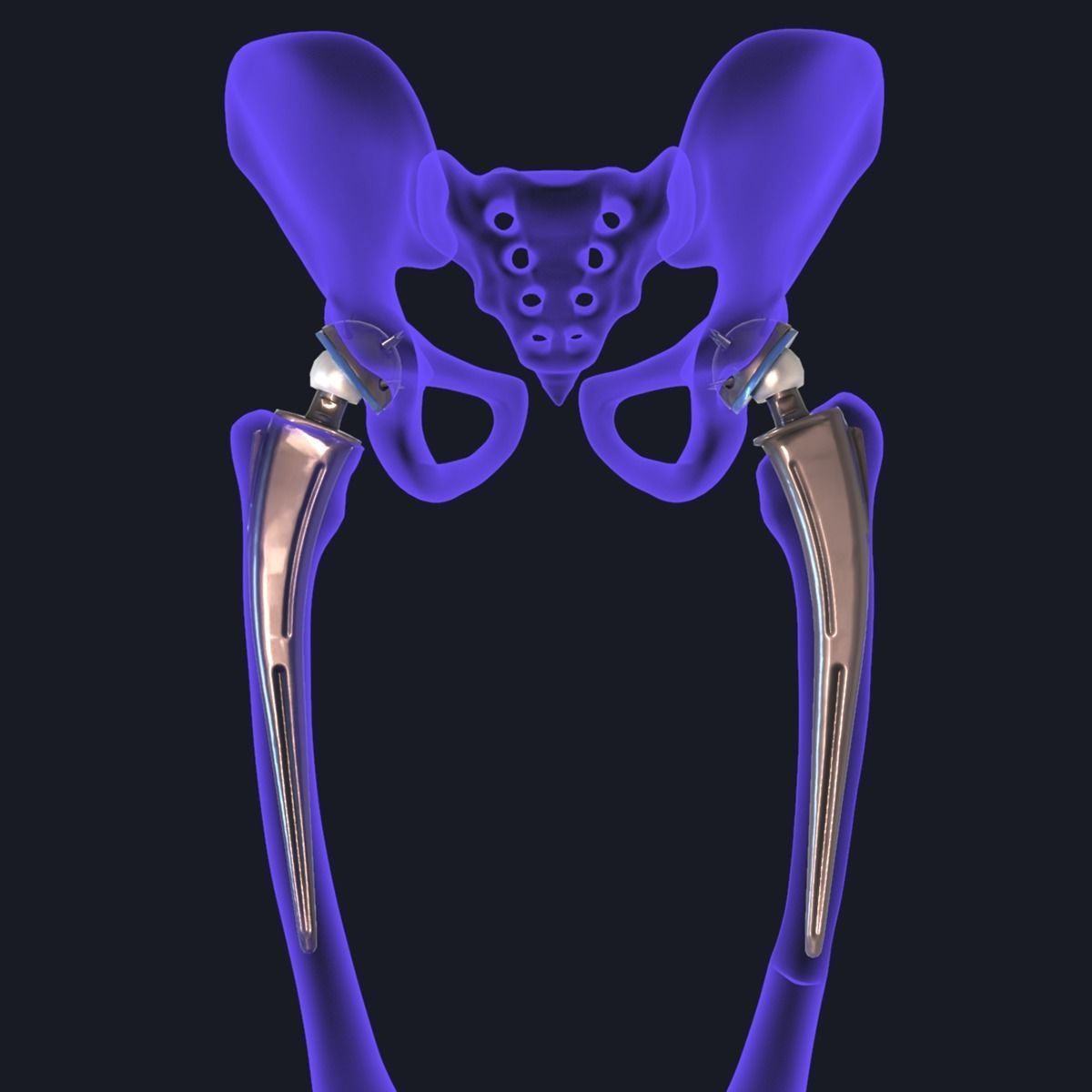 Hip replacement implant installed in the pelvis bone 3D model_20