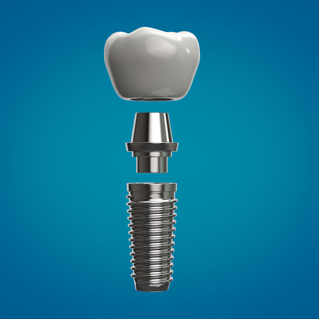 Tooth Implant 3D model_10