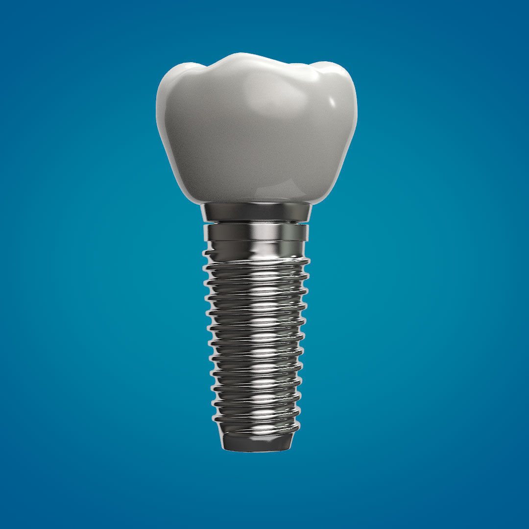 Tooth Implant 3D model_2