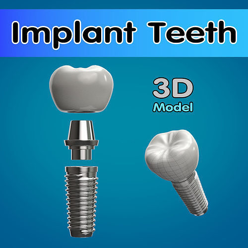 Tooth Implant  3D model