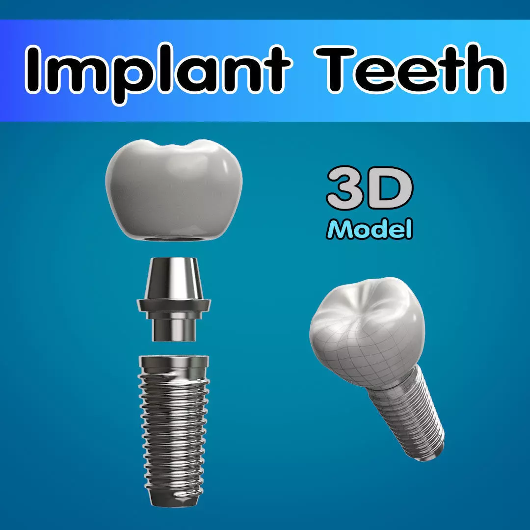 Tooth Implant 3D model_0