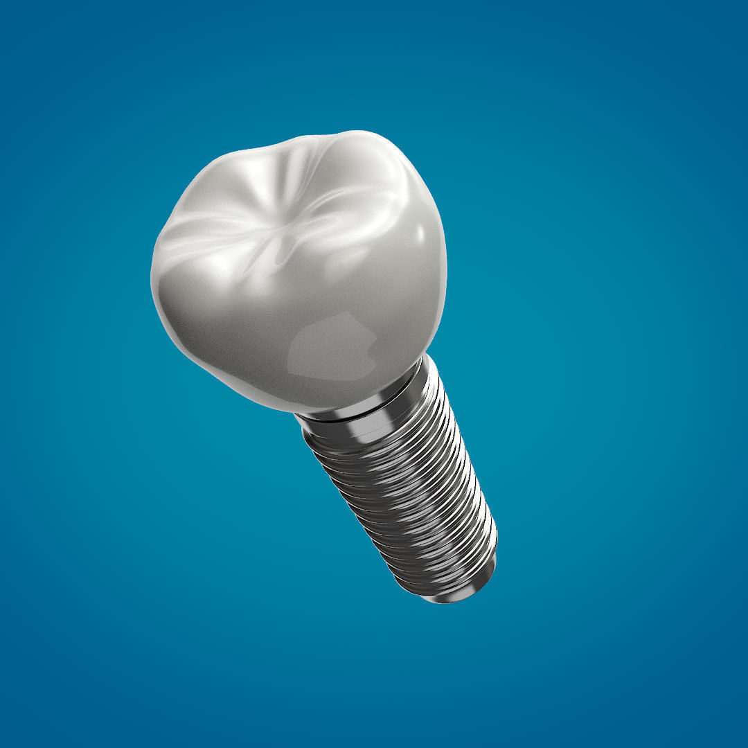 Tooth Implant 3D model_3