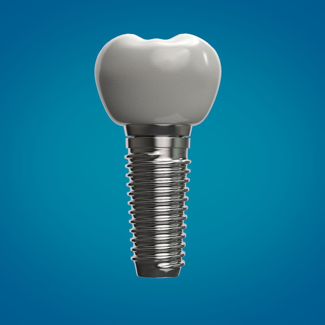 Tooth Implant 3D model_1