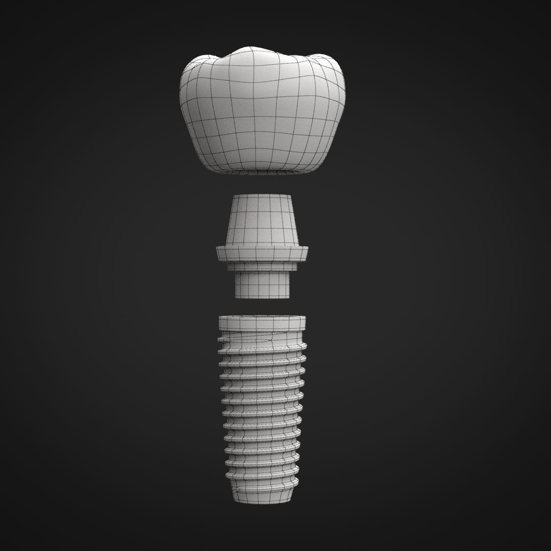 Tooth Implant 3D model_30