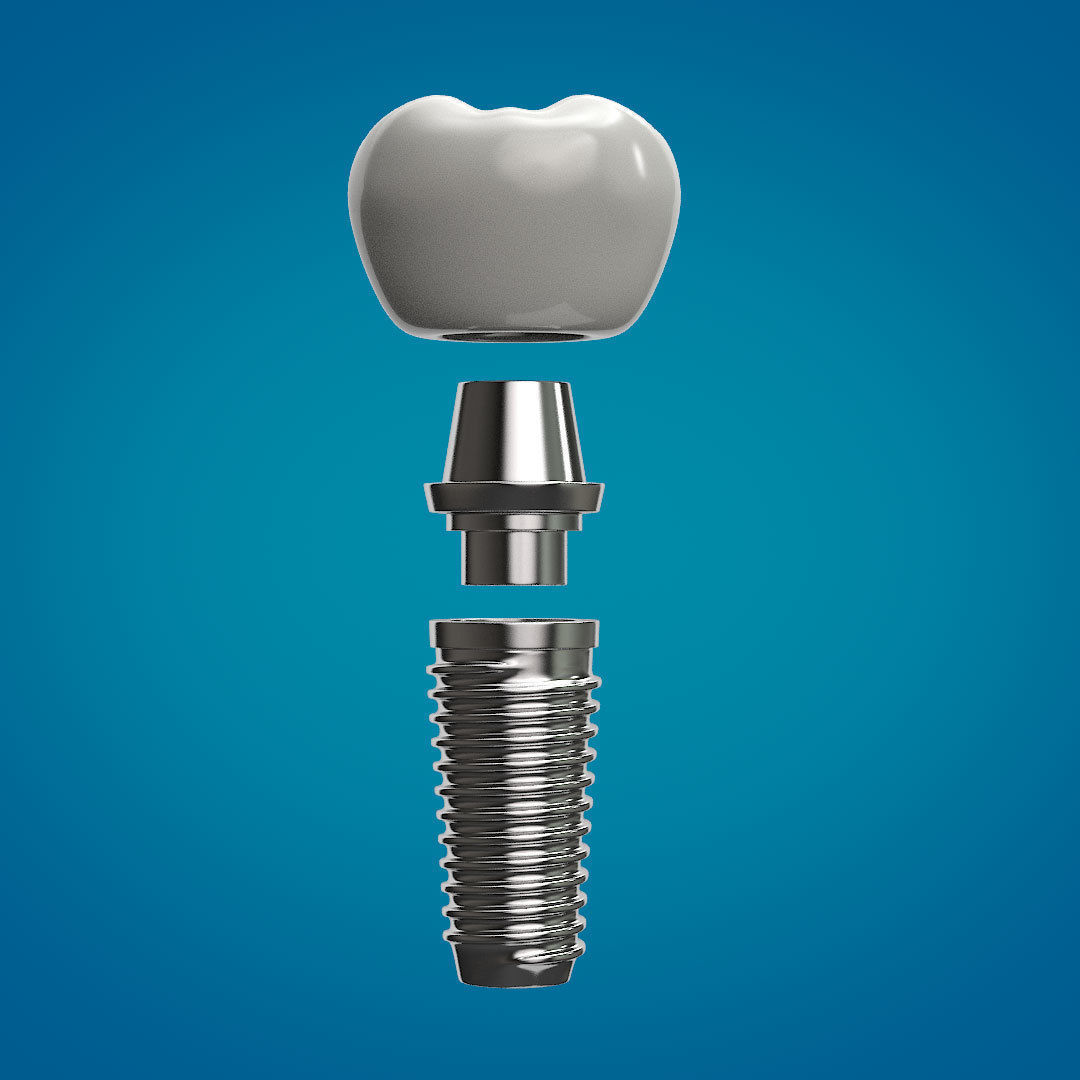 Tooth Implant 3D model_9