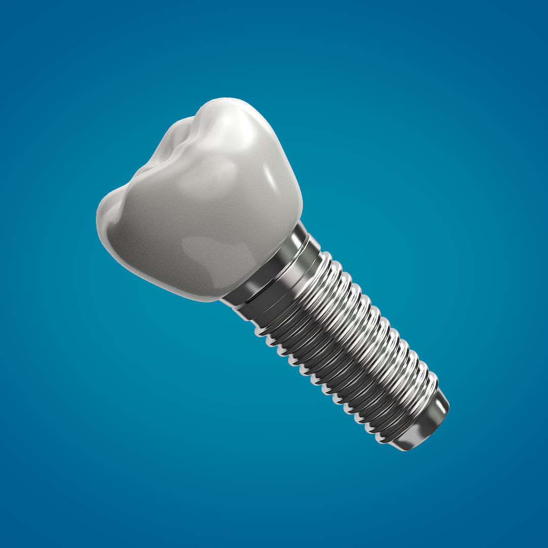 Tooth Implant 3D model_6