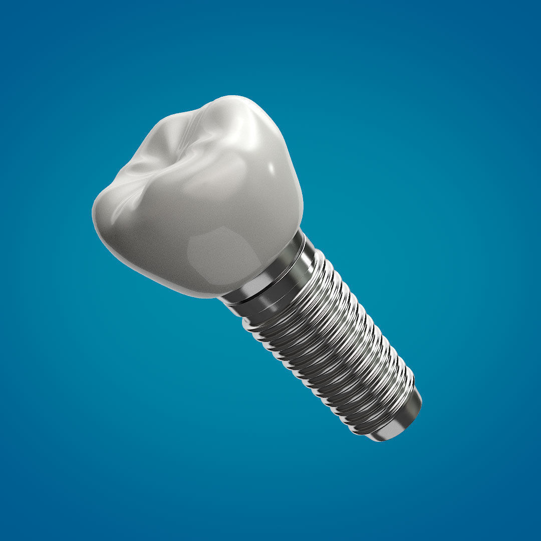 Tooth Implant 3D model_5