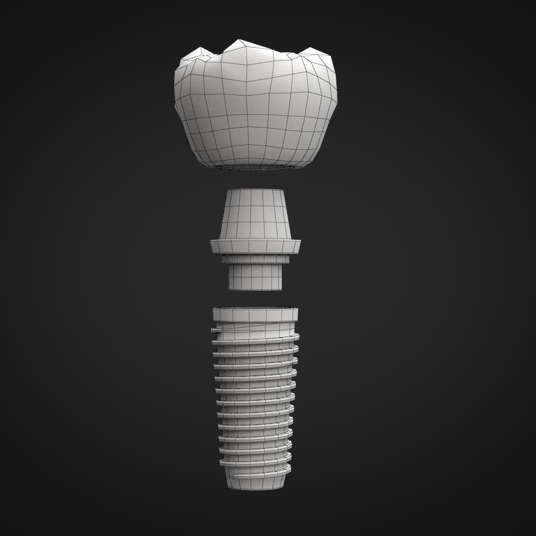 Tooth Implant 3D model_20