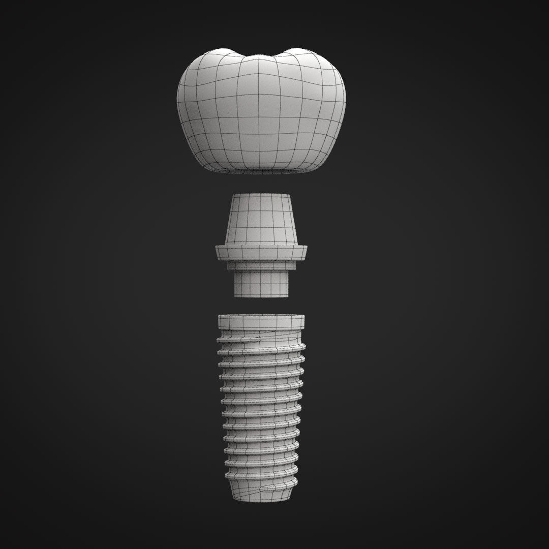 Tooth Implant 3D model_29