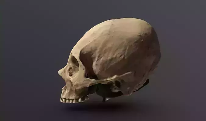 Human Skull Trepanation Photogrammetry 3D scan