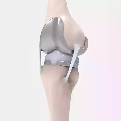 Knee Replacement 3D model