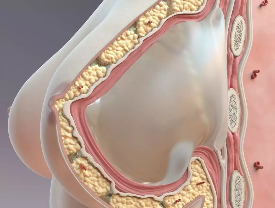 Cross Section Implant 3D model