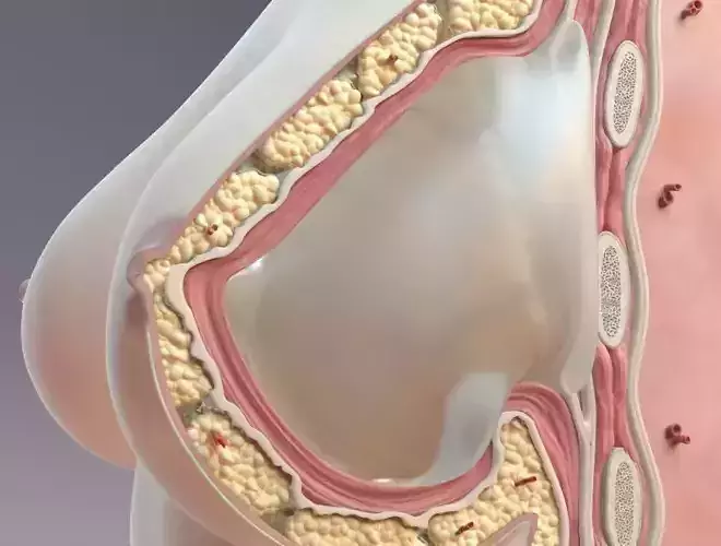 Breast Cross Section Implant