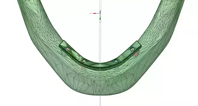 mandibular implant prosthesis - All-on-Four 3D model