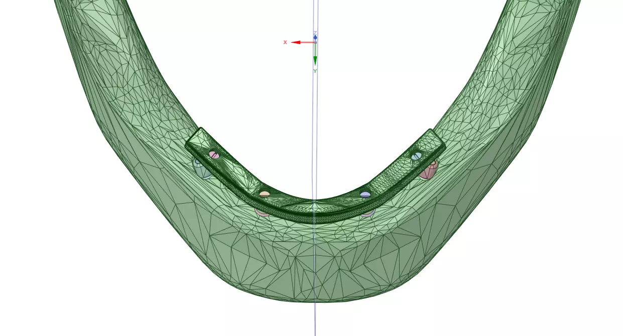 mandibular implant prosthesis - All-on-Four 3D model