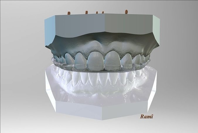 Digital Bite-guard Appliance 3D print model