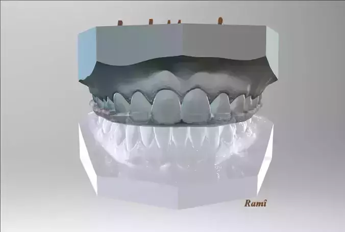 Digital Bite-guard Appliance 3D print model