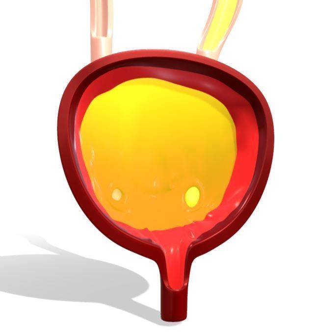 Type 4 - Vesicoureteral Reflux - VUR - Pediatric Surgery 3D model_7