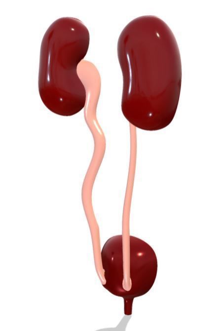 Type 4 - Vesicoureteral Reflux - VUR - Pediatric Surgery 3D model_4