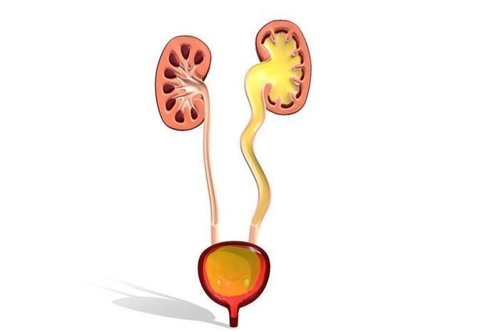 Type 4 - Vesicoureteral Reflux - VUR - Pediatric Surgery 3D model