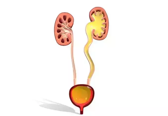 Type 4 - Vesicoureteral Reflux - VUR - Pediatric Surgery 3D model