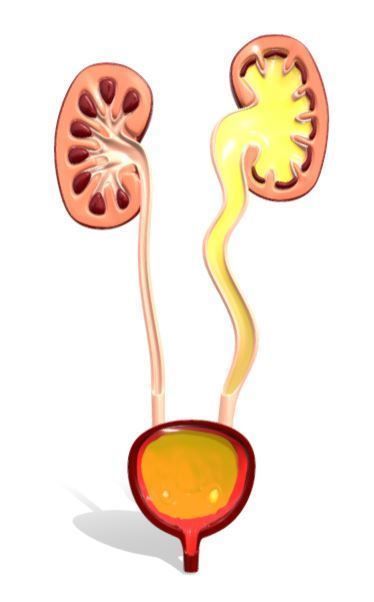 Type 4 - Vesicoureteral Reflux - VUR - Pediatric Surgery 3D model_2