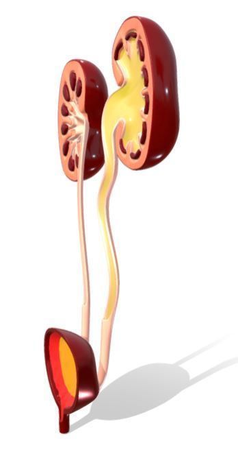 Type 4 - Vesicoureteral Reflux - VUR - Pediatric Surgery 3D model_6