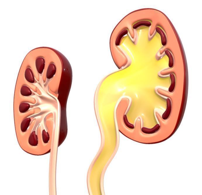 Type 4 - Vesicoureteral Reflux - VUR - Pediatric Surgery 3D model_8